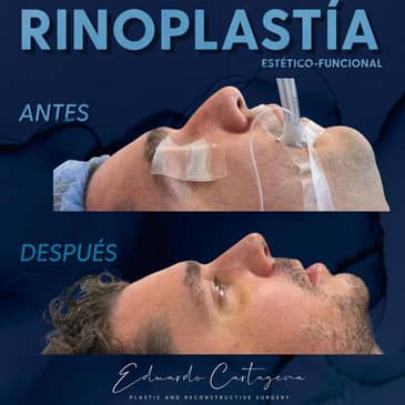 Slider image (7) Dr. Eduardo Cartagena Plastic and Reconstructive Surgeon